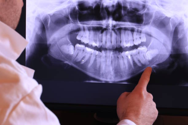 Best Emergency Dental Care for Broken or Chipped Teeth in Yosemite Lakes, CA