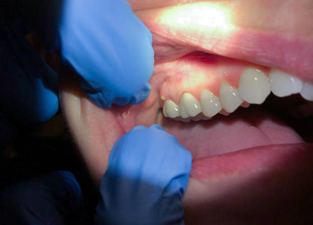 Best Emergency Treatment for Dental Infections or Abscesses in Yosemite Lakes, CA